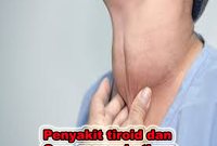 penyakit tiroid dan cara mengobatinya