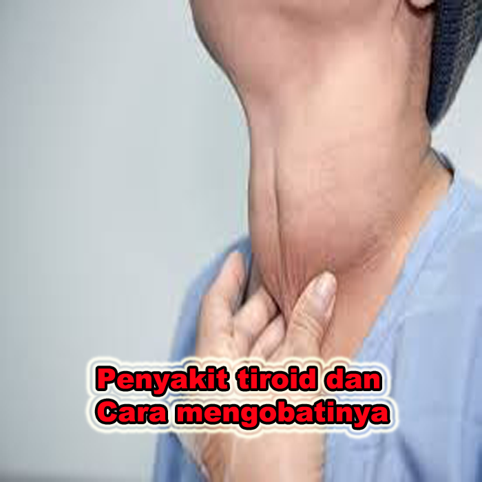 penyakit tiroid dan cara mengobatinya
