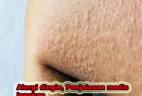 ALERGI DINGIN, PENJELASAN MEDIS LENGKAP