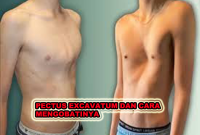 PECTUS EXCAVATUM DAN CARA MENGOBATINYA