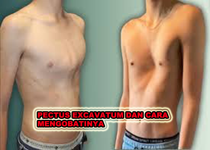 PECTUS EXCAVATUM DAN CARA MENGOBATINYA