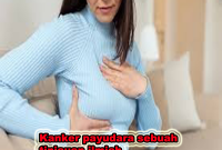 kanker payudara sebuah tinjauan ilmiah