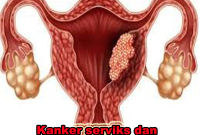 kanker serviks dan cara pencegahannya