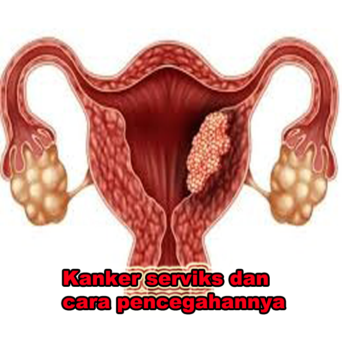 kanker serviks dan cara pencegahannya